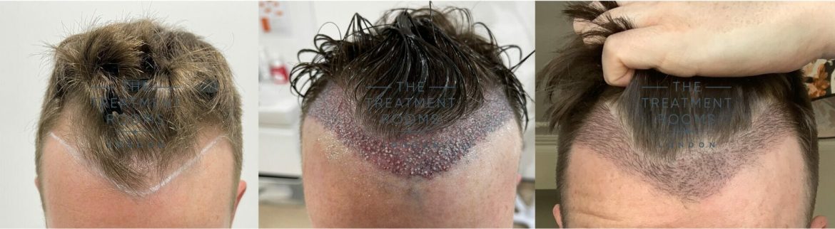 What should you expect from your trip through a hair transplant? A basic guide to the procedure